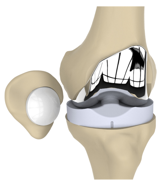 Axis Knee System
